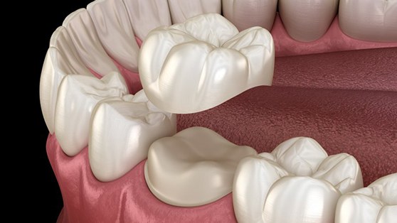 a 3D illustration of a dental crown 